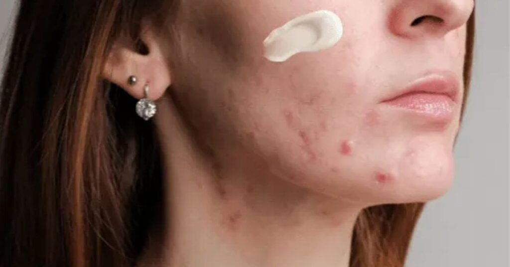 Principia kit anti-acne funciona: Principia kit anti-acne como usar? Confira