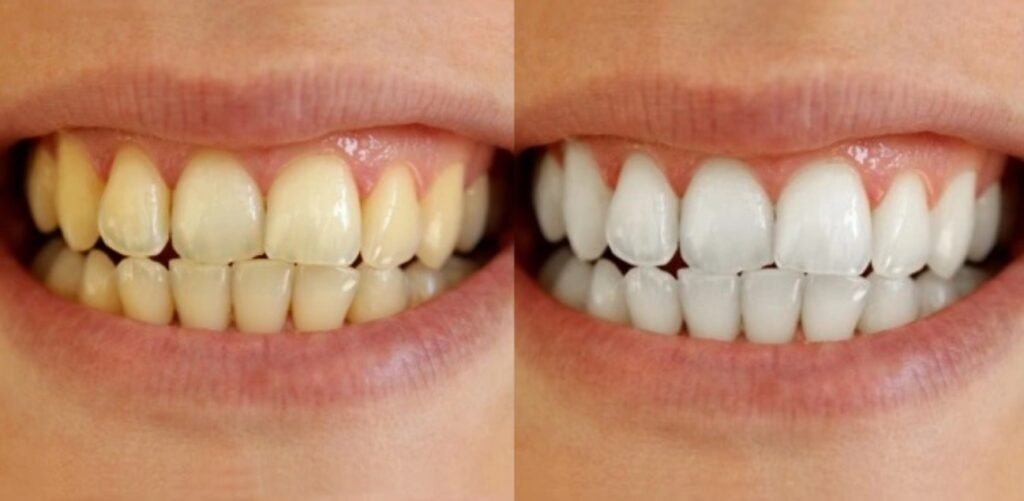 Hismile v34 tiras de clareamento dental