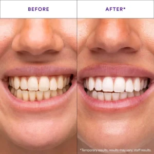 Tiras de branqueamento de dentes roxas: Original Oralhoi