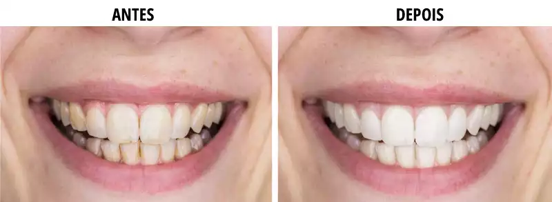 Tiras clareadora dental v34 funciona? Minha experiência