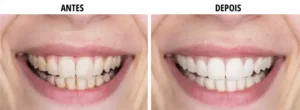 Fita roxa clareadora dental: Tiras Clareadoras de Dentes Roxas 14 Unidades